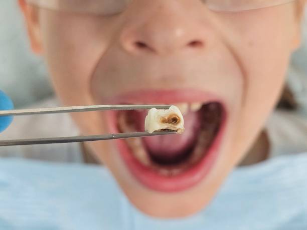 Best Pediatric Emergency Dentist in Silverthorne, CO