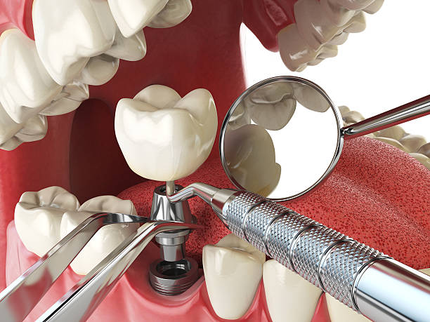 Best Emergency Wisdom Teeth Removal in Silverthorne, CO